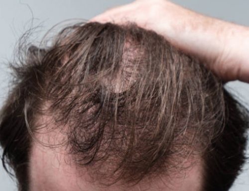 Deconstructing the Science behind Hair Loss