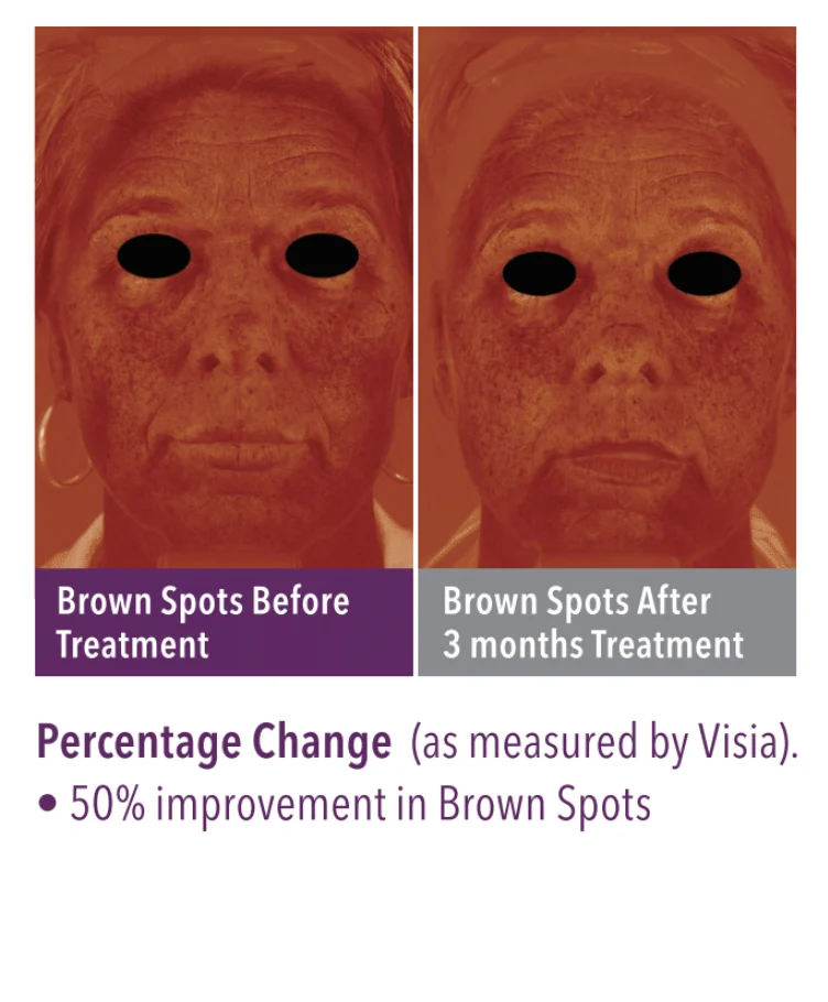 SkinGenuity Brown Spots Skin Health Brown Spots
