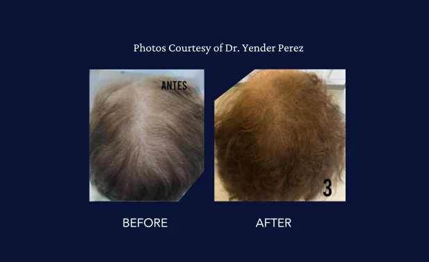 SkinGenuity Gallery Dr Yender Perez Hair Restoration Dr Perez