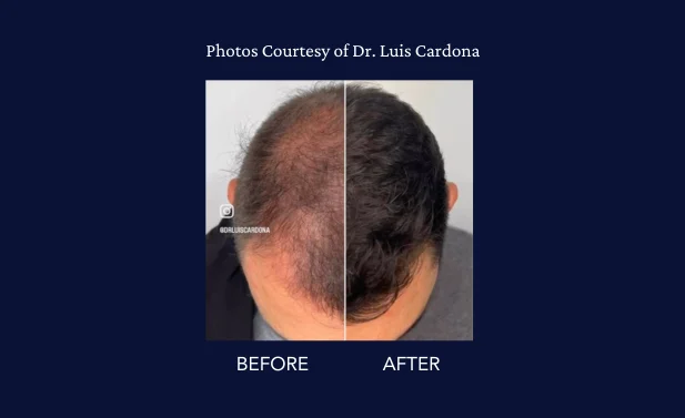 SkinGenuity Gallery Images Dr Cardona Hair Restoration Dr Luis Cardona