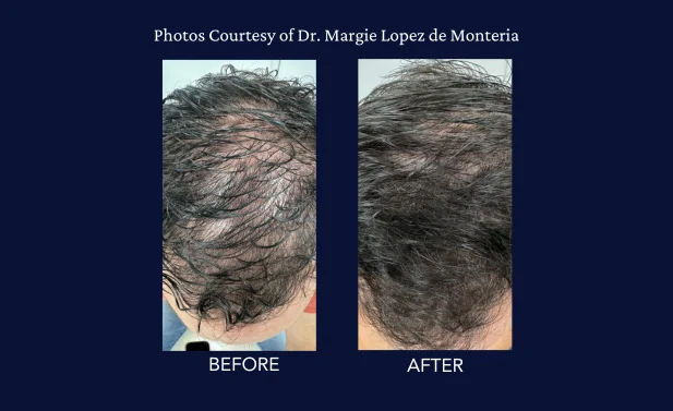 SkinGenuity Gallery Images Dr Lopez Dr Lopez Before and After Hair Restoration