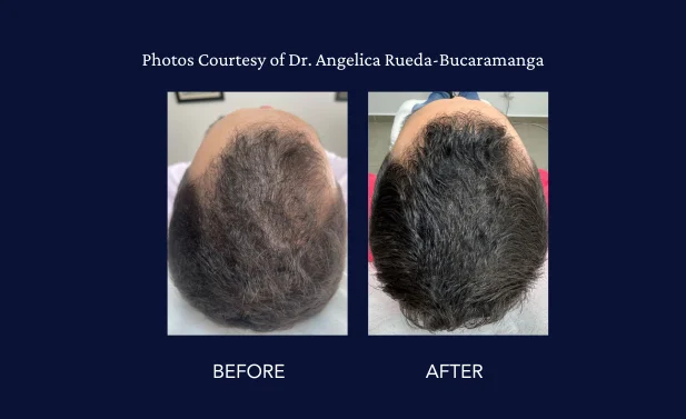 SkinGenuity Gallery Images Dr Rueda Hair Restoration Results Dr. Rueda Bucaramanga