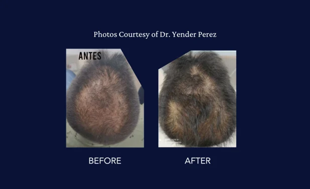 SkinGenuity Gallery Images Dr Yender Perez 2 Hair Restoration Dr. Yender Perez
