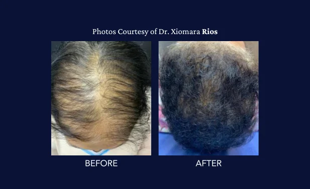 SkinGenuity Gallery Images Dr. Rios Dr. Rios Before and After Hair Restoration