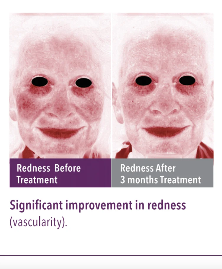 SkinGenuity Redness Skin Health Redness