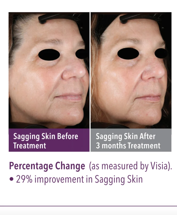 SkinGenuity Sagging Skin Skin Health Sagging Skin