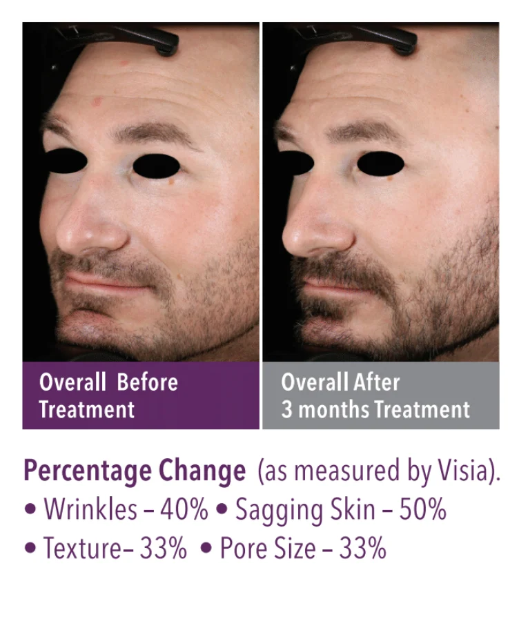 SkinGenuity Wrinkles and Texture Skin Health Wrinkle and Texture